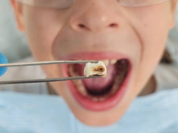 Best Emergency Wisdom Teeth Removal in Fortuna, CA