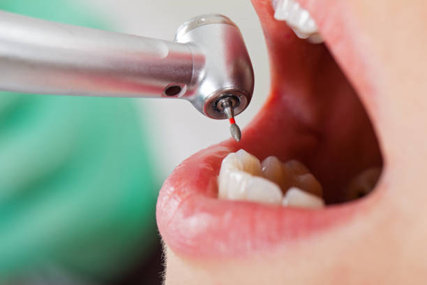 Best Emergency Tooth Extraction in Fortuna, CA